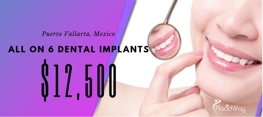All on 6 Dental Implants cost in Puerto Vallarta, Mexico